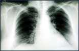 X-ray